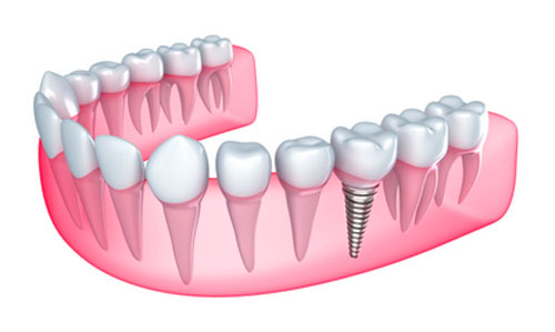 Benefits Of Dental Implants For Seniors