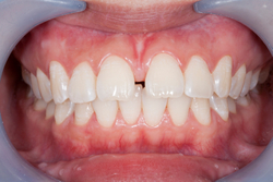 What Should I Do If I Am Worried About Gum Disease?