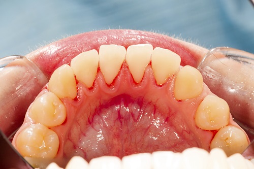 Easy Ways to Spot Gum Disease at Home on Your Own