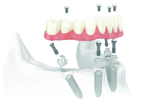 Teeth in a Day