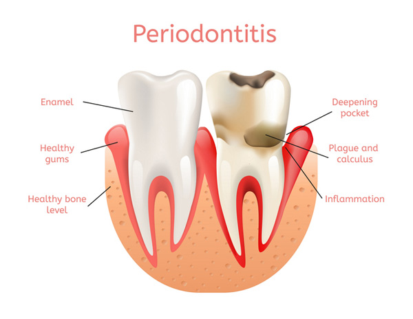 Dental Consequences of Gum Disease