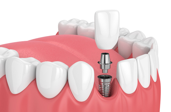 How Long Do Dental Implants Last?
