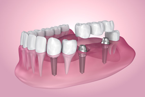 Multiple Tooth Implants