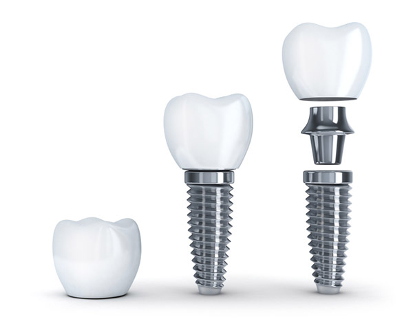 History of Dental Implants