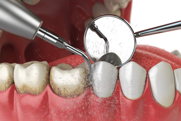 Periodontal Therapy