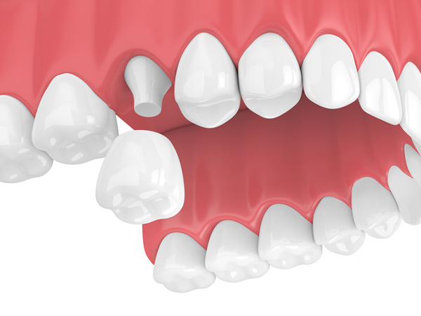 Dental Crown Lengthening