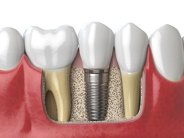 Bone & Gum Regeneration