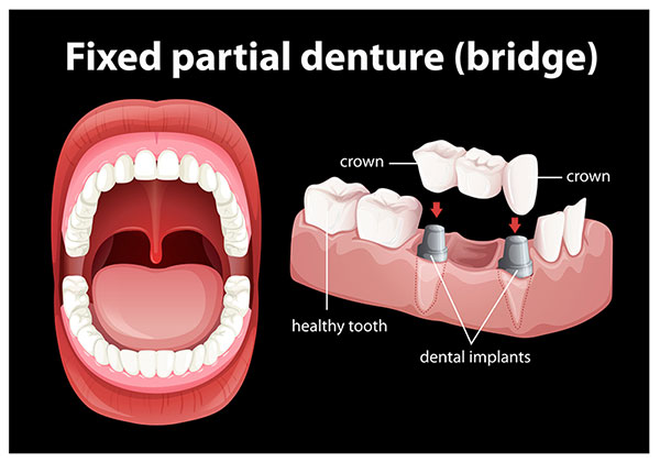 Dentures to Implant Bridge