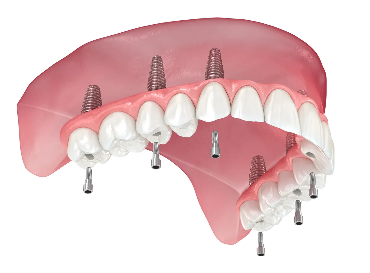 All-on-4/6 Implants