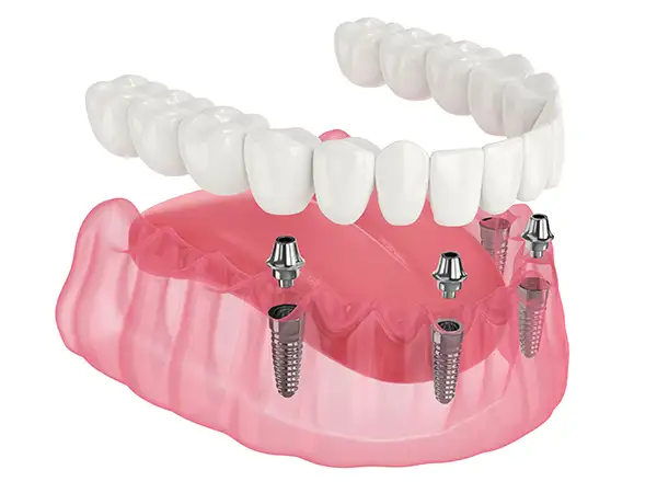 Maintenance Cleanings After All-on-4/6 Dental Implants
