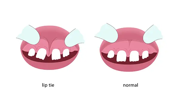 Frenectomy