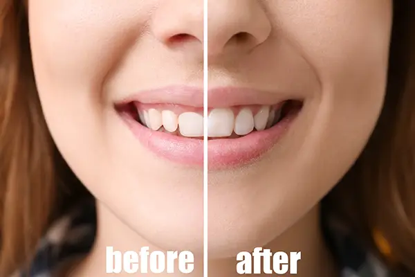 Gum Contouring and Reshaping