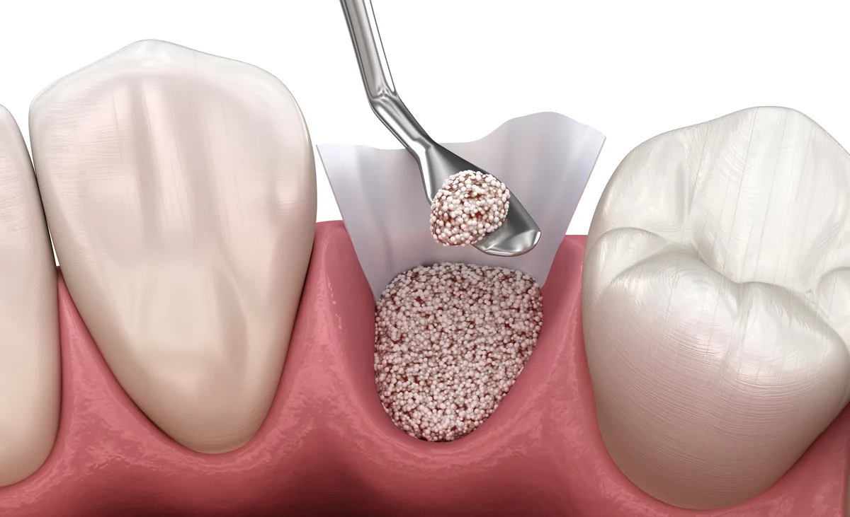 Tooth Extraction Site Preservation