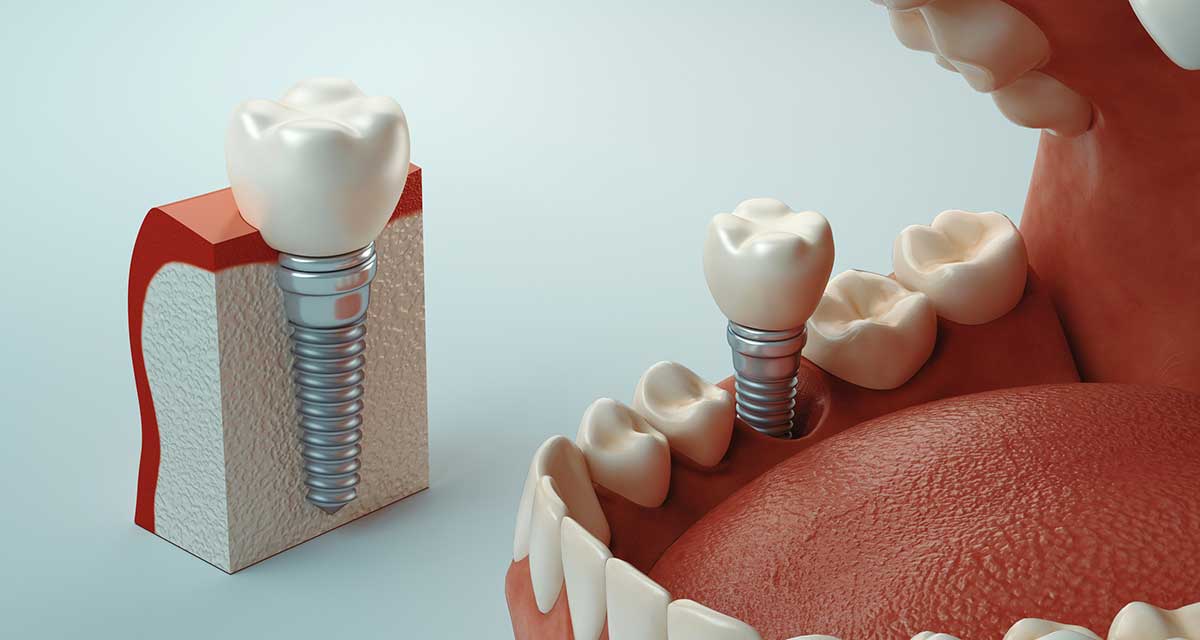 Tooth Socket Graft
